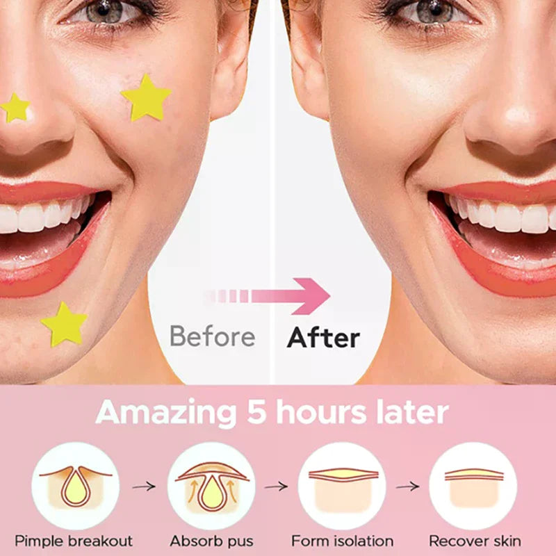 360pcs Invisible Heart Star Face Skin Care Acne Pimple Patch Professional Healing